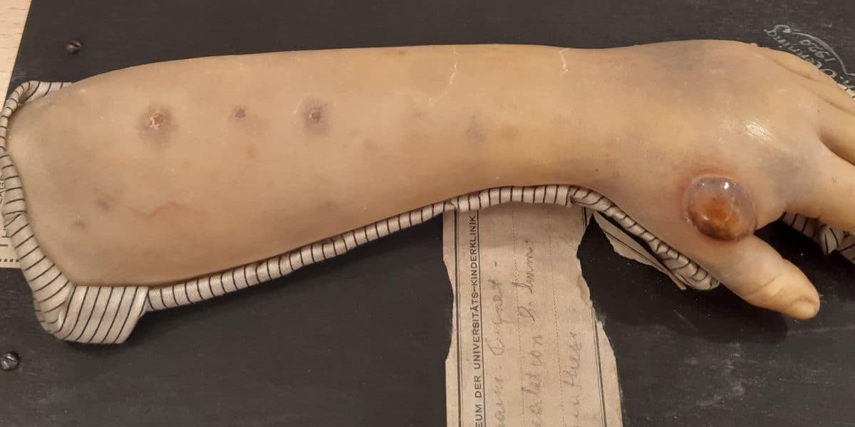 Was Seuchen in Österreich bewegten