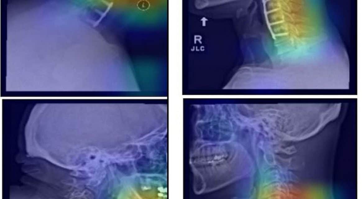 KI-Doktor: Neuronale Netze lernen von Röntgenbildern