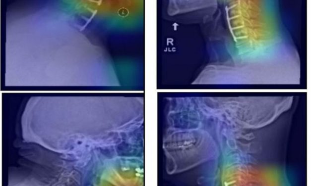 KI-Doktor: Neuronale Netze lernen von Röntgenbildern