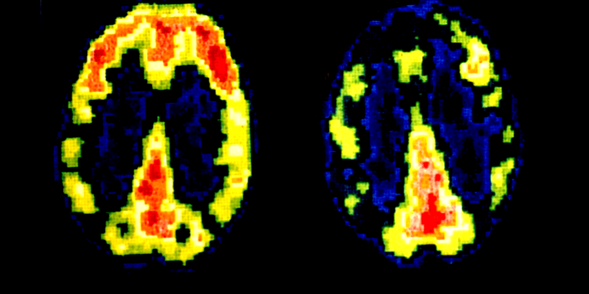 Wie das Gehirn eines Mörders aussieht