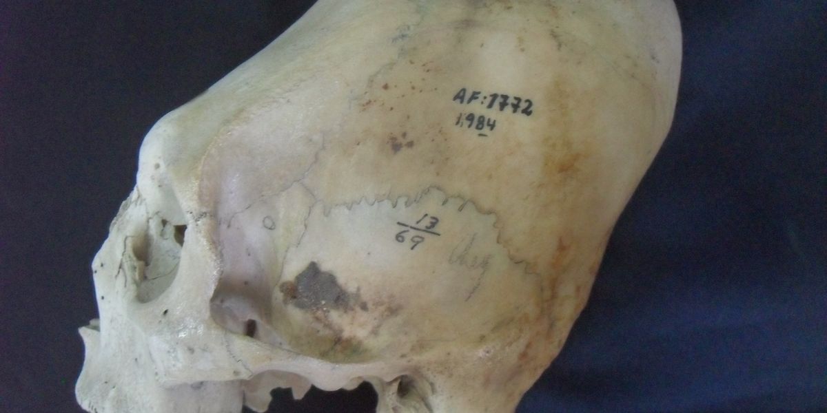 Was mysteriöse peruanische Turmschädel über Identität verraten