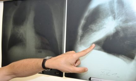 Lungenkrebs: Spezielle Früherkennung reduziert Todesfälle erheblich