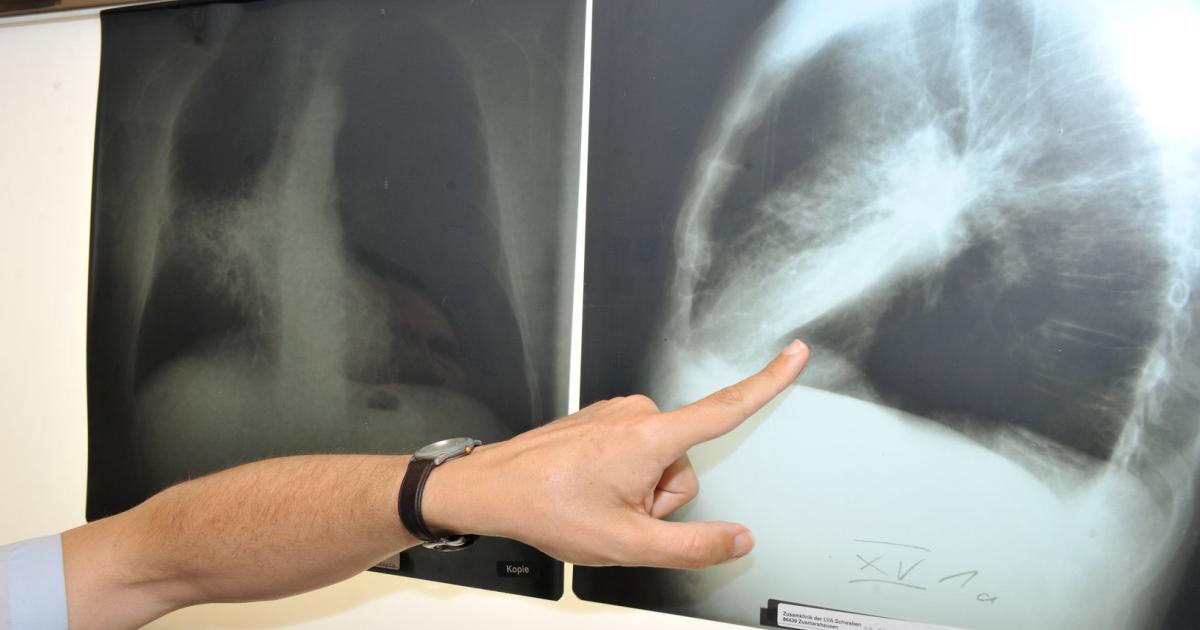 Lungenkrebs: Spezielle Früherkennung reduziert Todesfälle erheblich