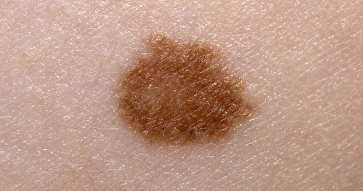 Hautkrebs-Früherkennung: Mediziner entwickelten Handy-App