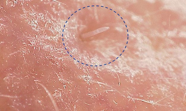 Winzige Untermieter leben, haben Sex und sterben auf unseren Gesichtern
