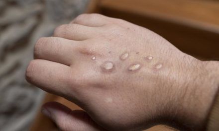 Affenpocken: EU-Arzneimittelbehörde prüft Impfstoff