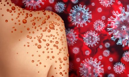 95 Prozent der Affenpocken-Infektionen durch sexuelle Kontakte